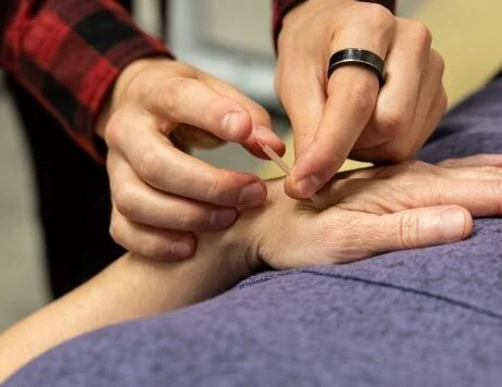 Acupuncture
