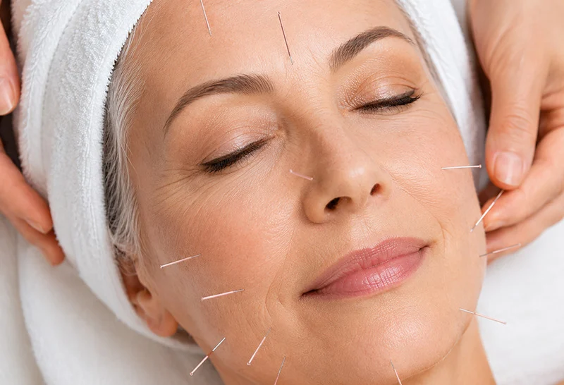 Cosmetic Acupuncture