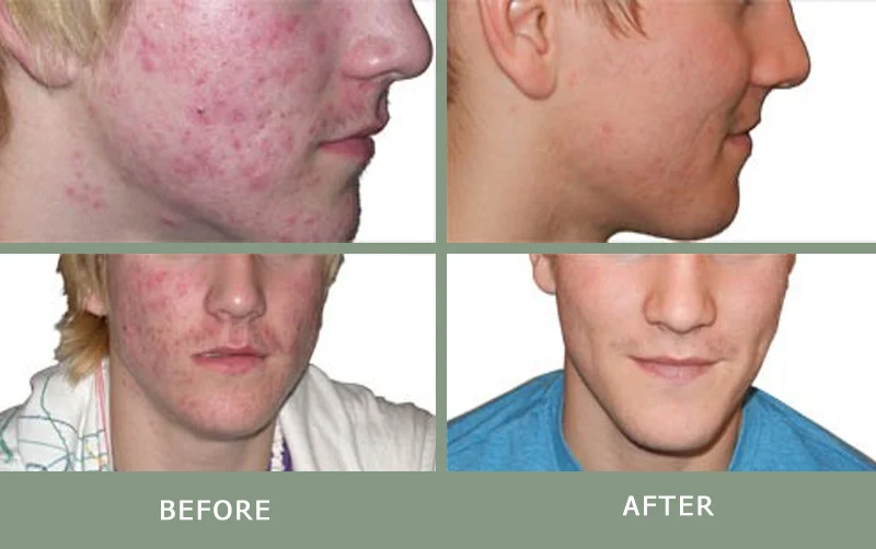 LED Light Therapy for Acne